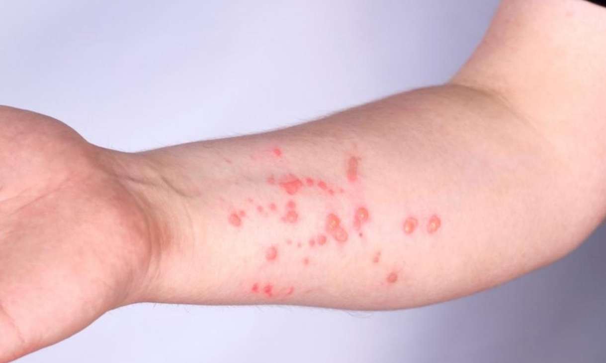 Sobe para 140 número de casos confirmados de Mpox no país, em 2026